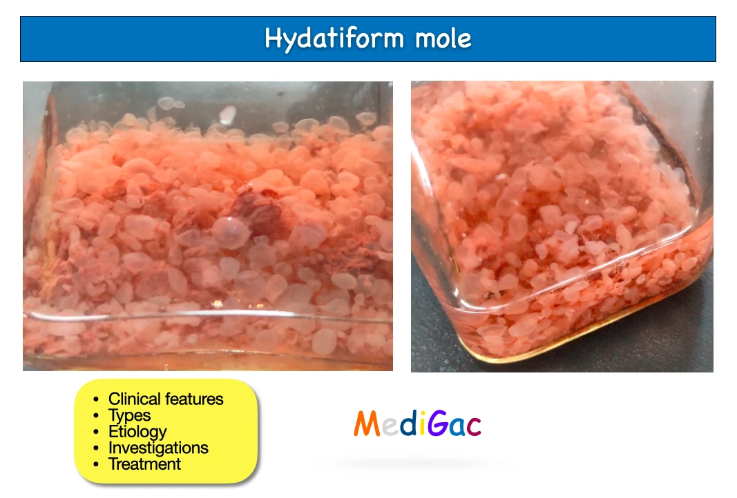 Hydatiform mole